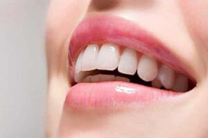 لمینت دندان چیست ؟موارد کاربرد لمینت دندان; تفاوت با کامپوزیت