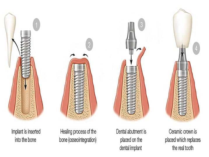 مراحل ایمپلنت دندان عکس 