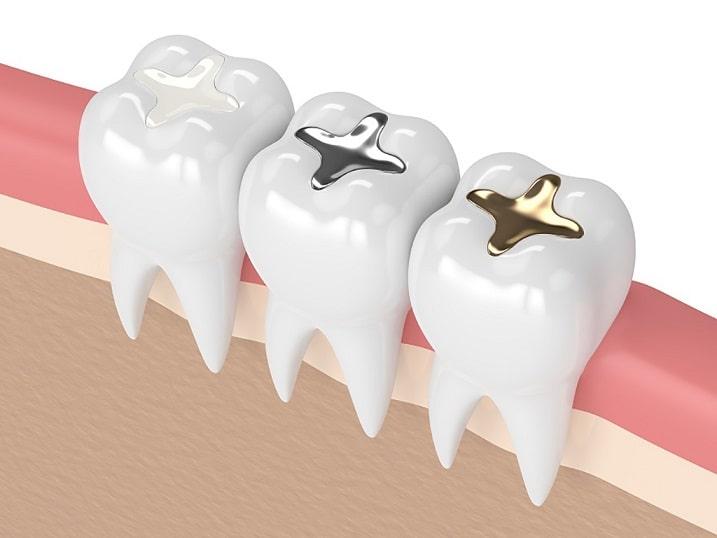 آمالگام، طلا، کامپوزیت و رزین ازجمله مواد مورداستفاده برای پر کردن دندان می‌باشند