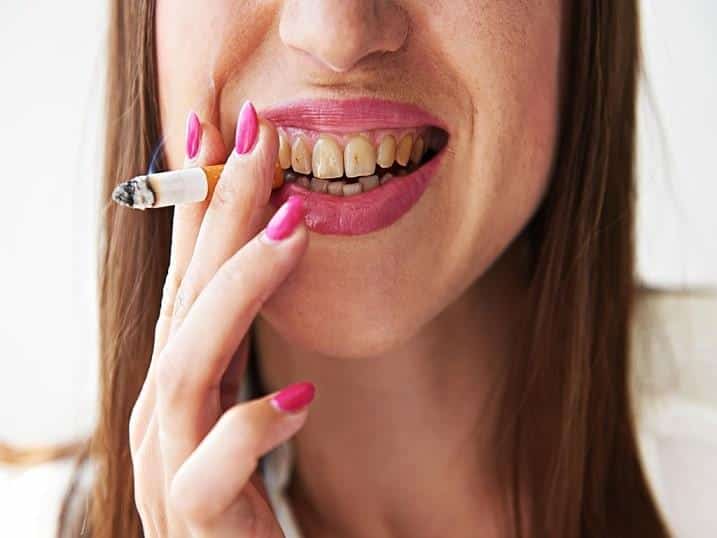 یکی از دلایلی تغییر رنگ دندان مصرف دخانیات است