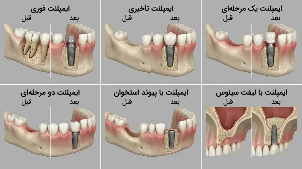 انواع ایمپلنت از نظر روش درمان