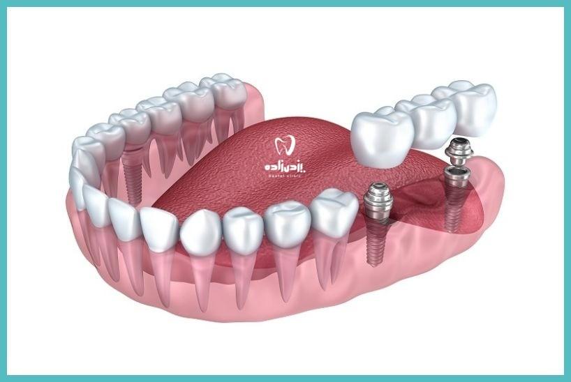 معایب و مشکلات ایمپلنتهای دندان چیست