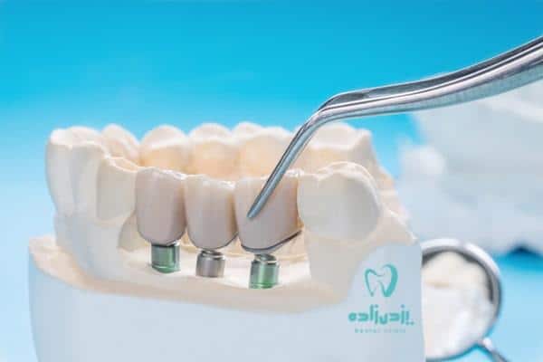 علت ادامه‌دار شدن درد ایمپلنت دندان