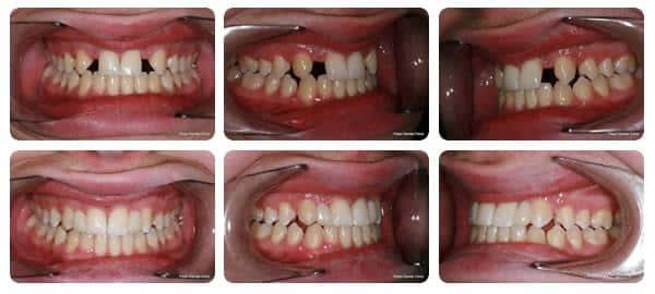 مراحل نصب بریج دندان 