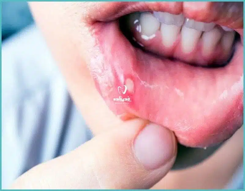 عفونت دندان عصب کشی شده