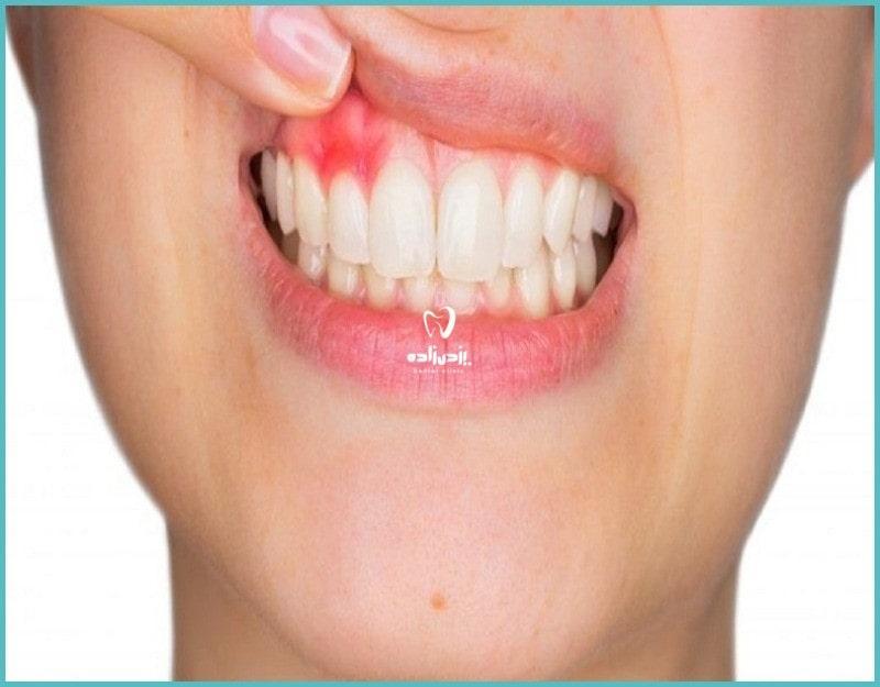 درمان عفونت دندان کشیده شده