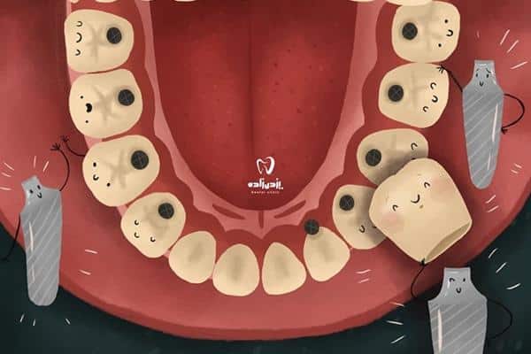 مراحل گام به گام ایمپلنت دندان