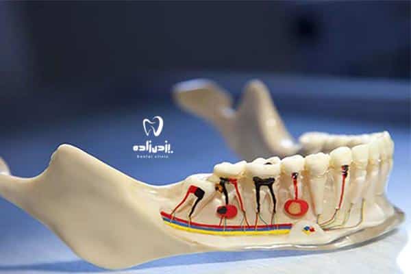 زمان عصب کشی دندان