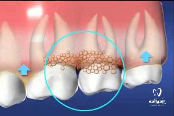 عفونت درونی دندان