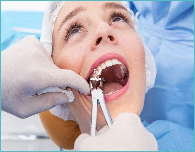 علت ها و مراقبتهای کشیدن دندان