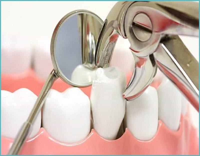 دلایل و علت های کشیدن دندان