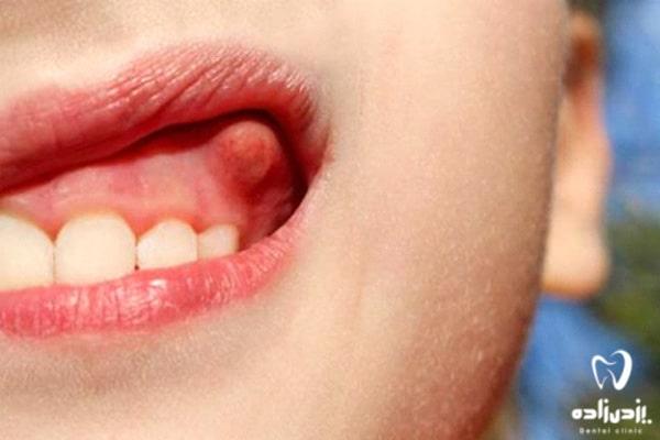 دلایل عفونت ریشه دندان