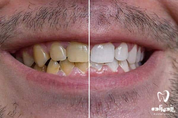 روش های سفید کردن دندان