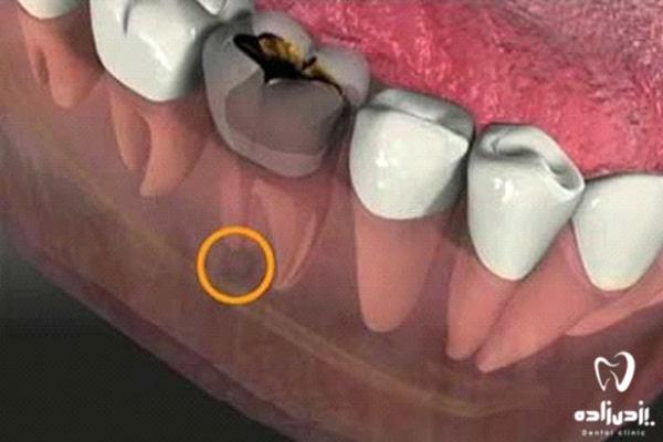 عوارض عفونت ریشه دندان