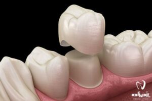 تاج دندان (Crown) چیست؟ عکس نحوه ی گذاشتن + ترمیم تاج دندان