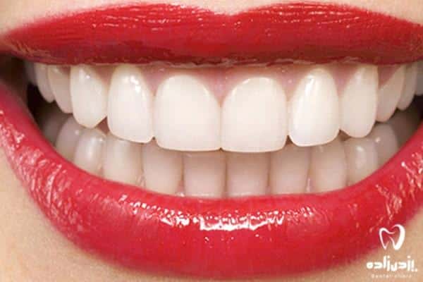پروتز ثابت دندان
