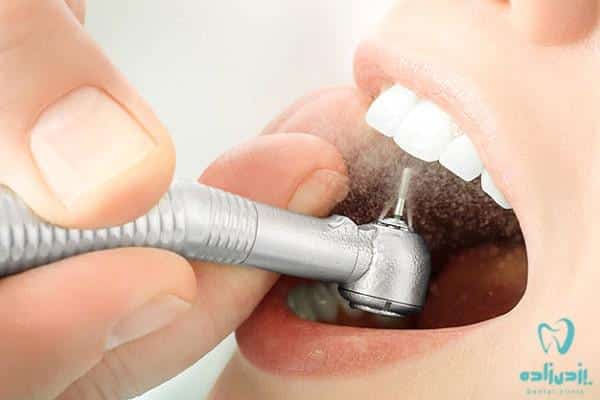 دندانپزشکی محافظه کارانه با هدف حفظ دندان های طبیعی