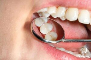 انواع کامپوزیت دندان 8 نوع + بهترین کامپوزیت دندان چیست؟