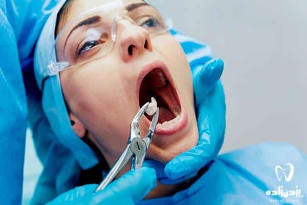 دوره نقاهت پس از جراحی دندان عقل نهفته
