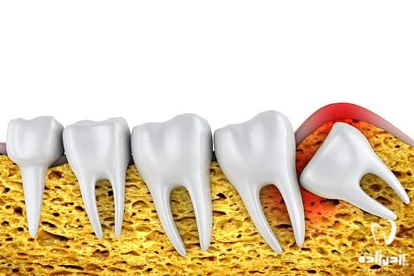 هزینه جراحی دندان عقل نهفته سال 1399 2020 دندانپزشکی دکتر یزدی زاده