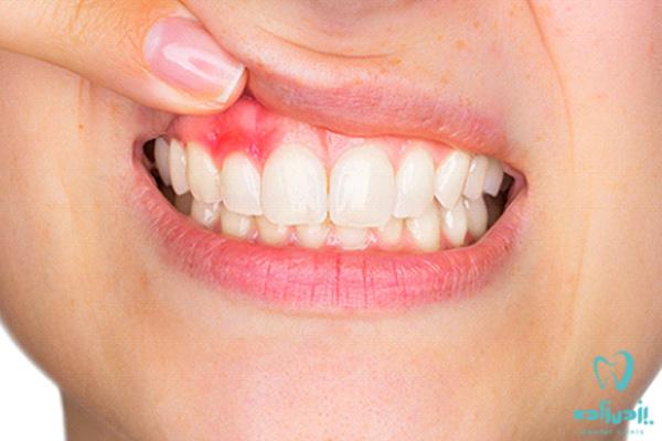 شناخت عوارض عفونت دندان در بدن