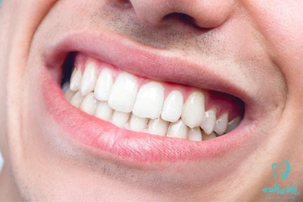 مزایای انواع کامپوزیت دندان